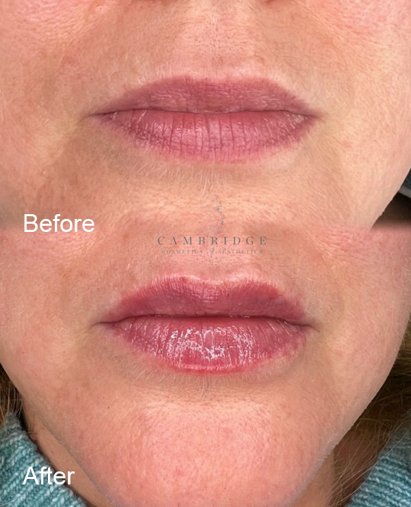 Aesthetic treatments in Cambridge - Lip Augmentation, before and after