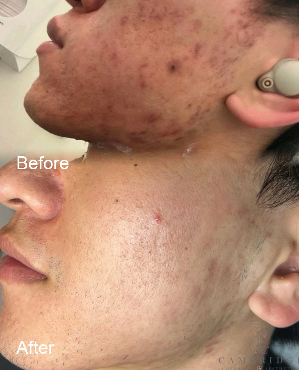 Microneedling in Cambridge before and after