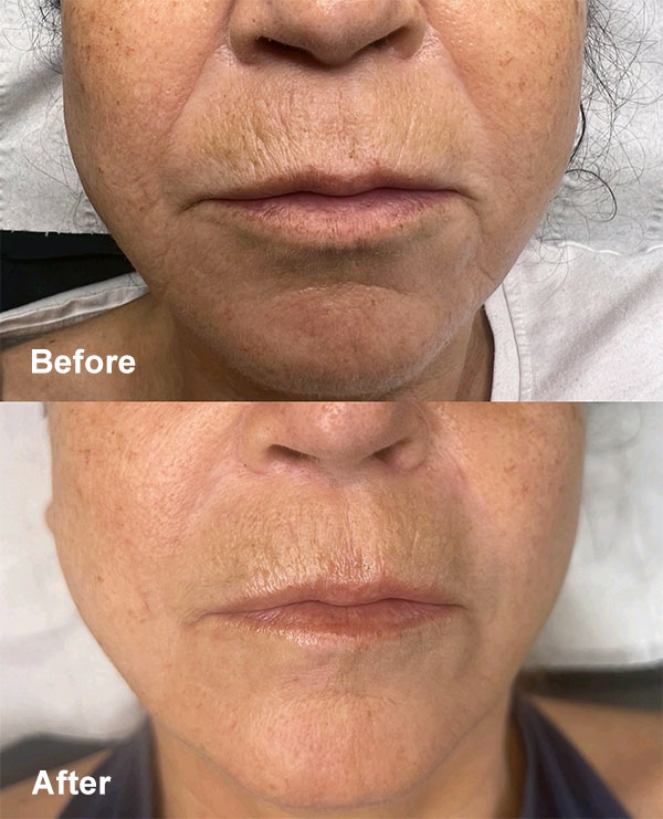 Aesthetic treatments in Cambridge - before and after