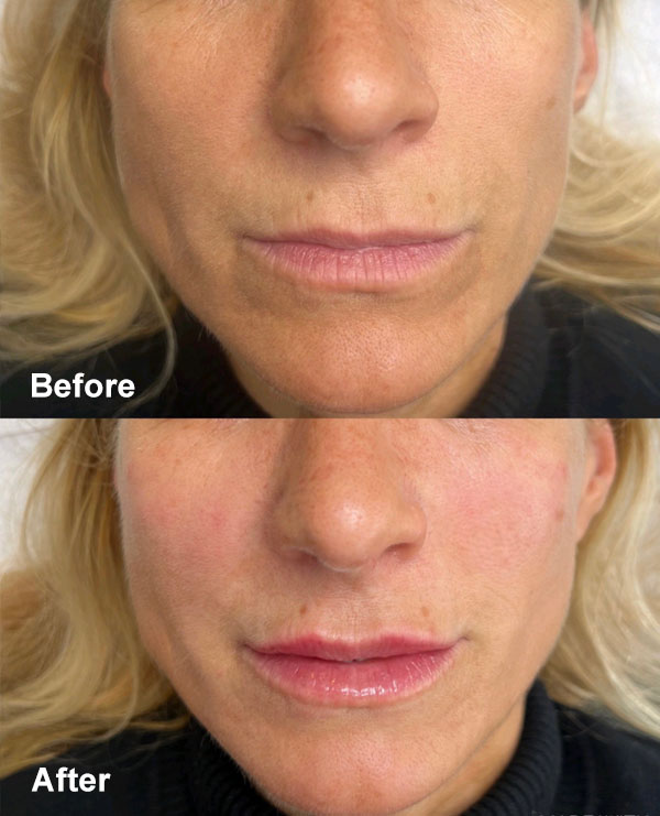 Aesthetic treatments in Cambridge - a before and after