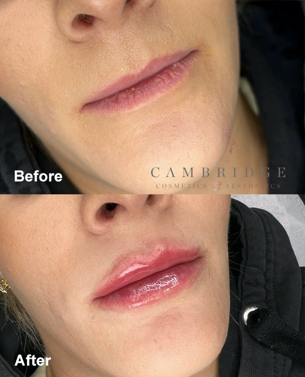 Aesthetic treatments in Cambridge - Lip Augmentation, before and after