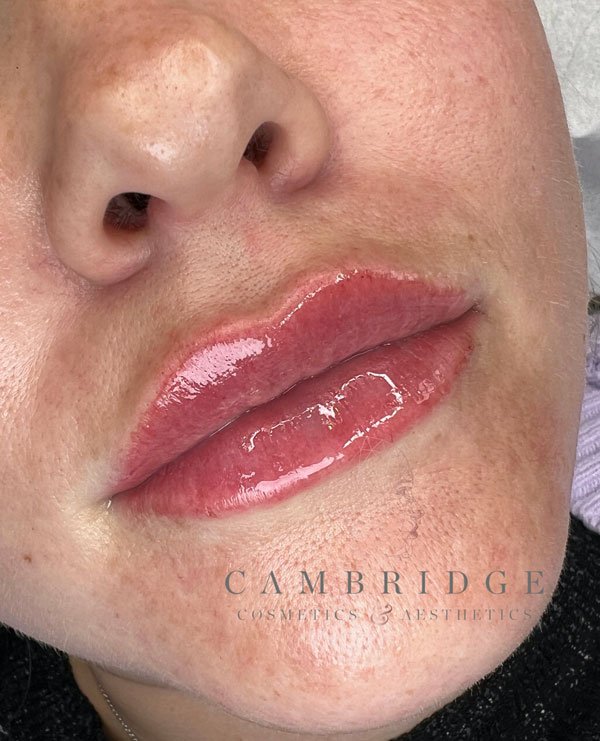 Aesthetic treatments in Cambridge - Lip Augmentation